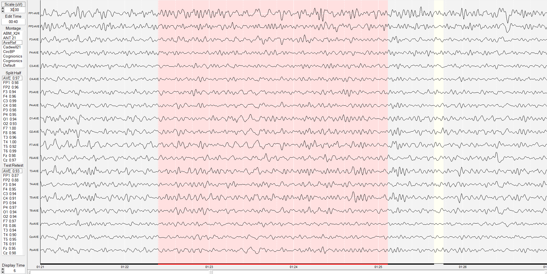 EEG evaluacion en madrid para neurofeedback